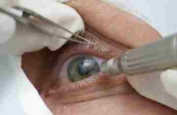  Cirurgia que altera cor do olho tem uso restrito para pessoas cegas 